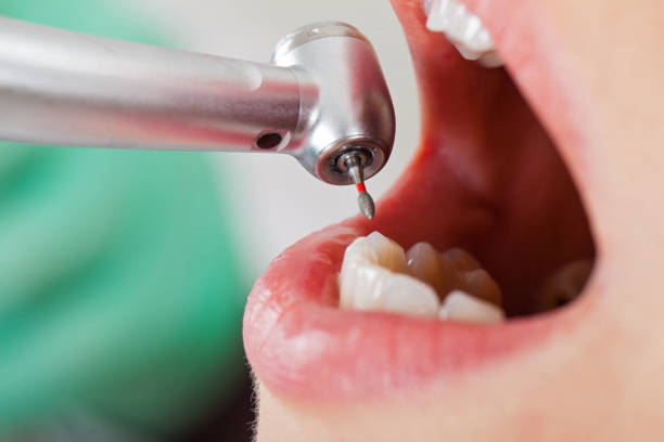 Best Emergency Dental Care for Broken or Chipped Teeth in Audubon, IA